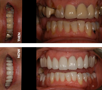 Smile Makeover at Start Smiling Dentist in Essex